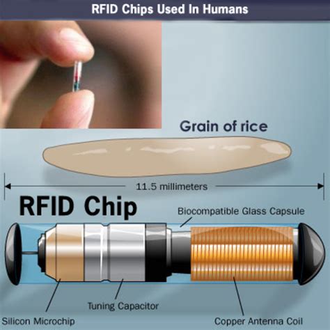 rfid chip removal surgery|how to get rfid implanted.